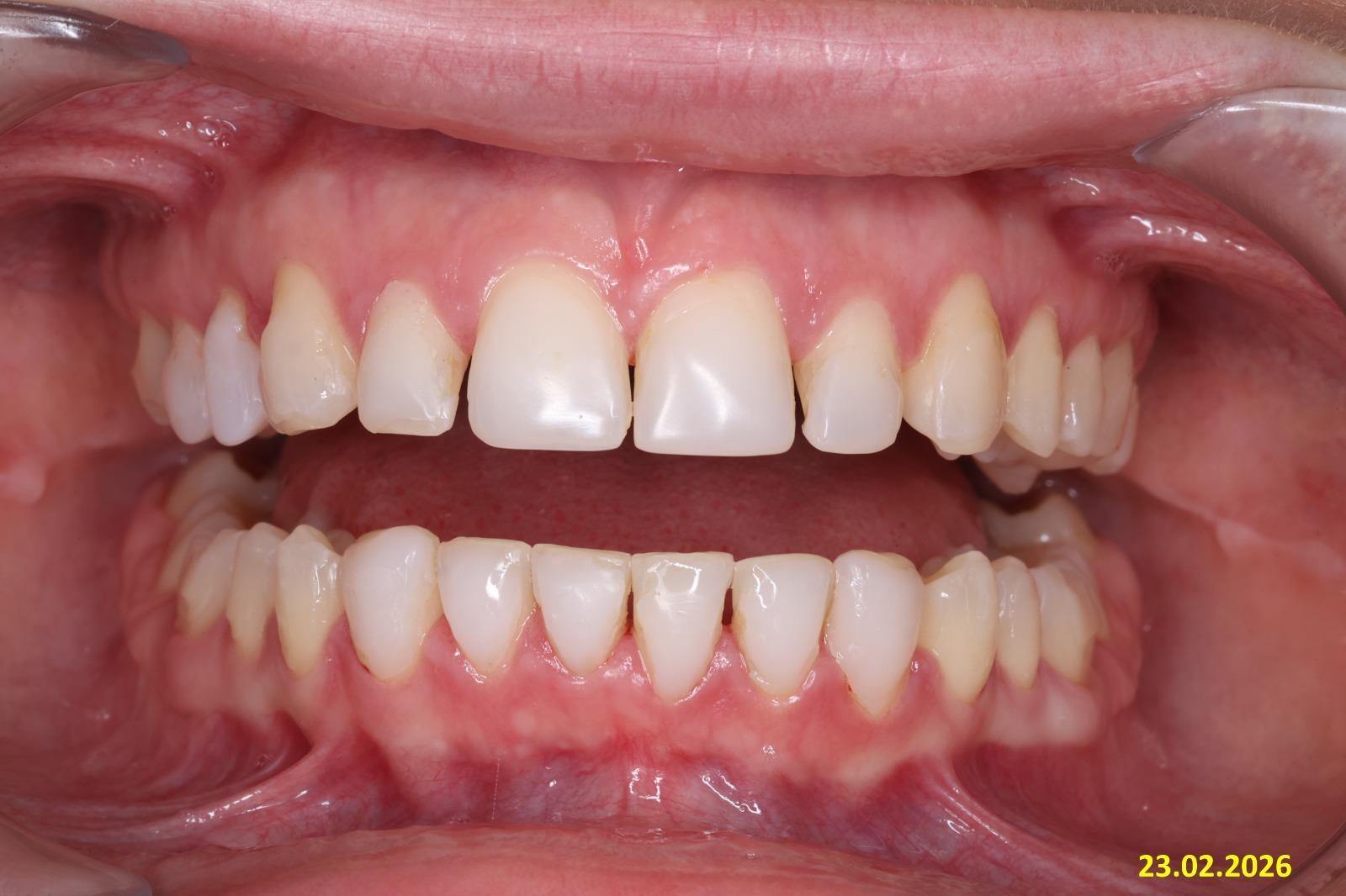Before treatment