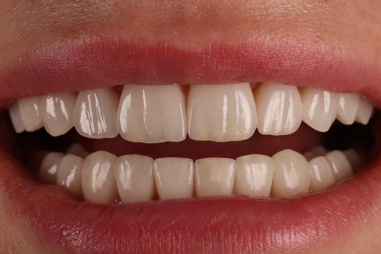 After treatment